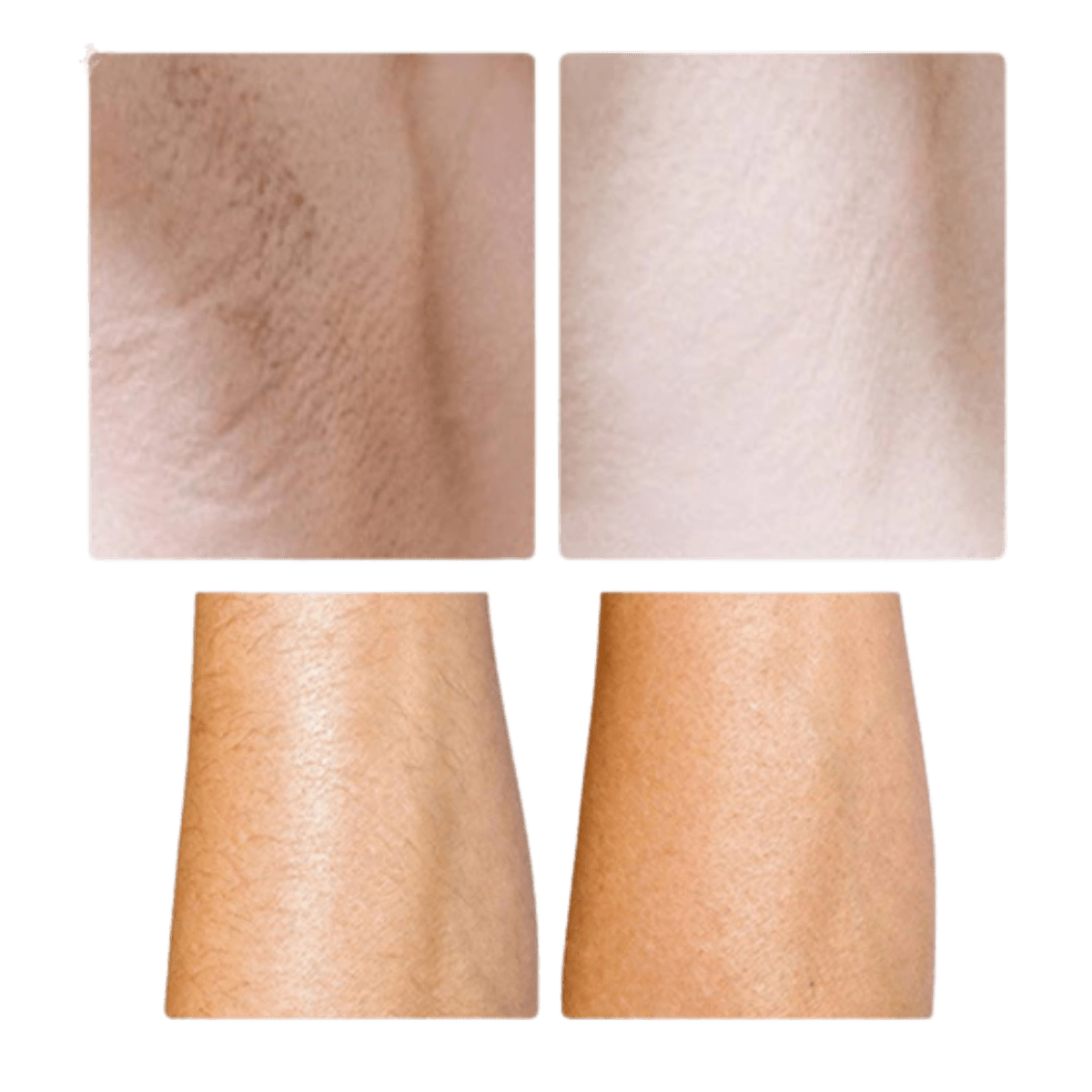 Lumist IPL Hair Removal & Skincare Device