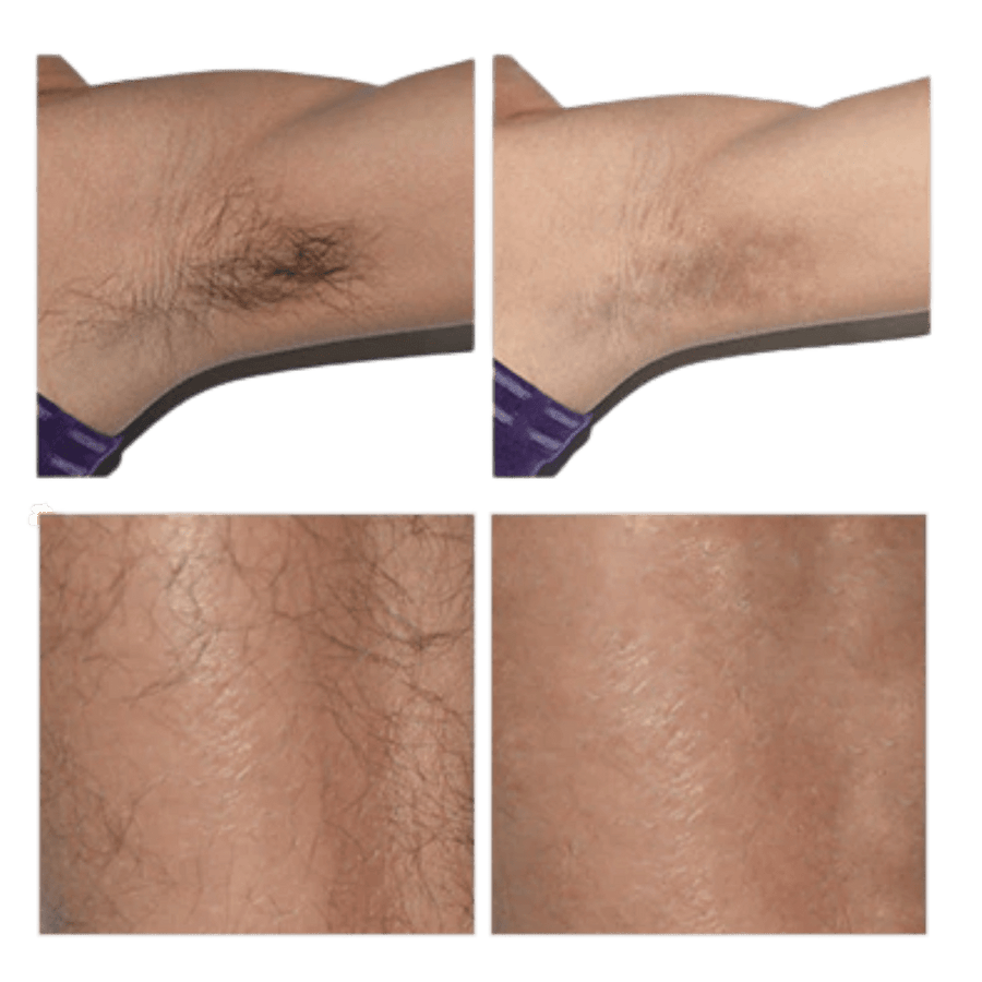 Lumist IPL Hair Removal & Skincare Device
