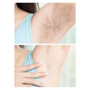 Lumist IPL Hair Removal & Skincare Device