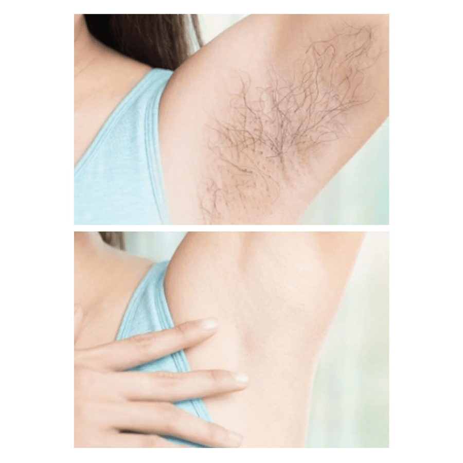 Lumist IPL Hair Removal & Skincare Device